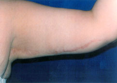 BRACHIOPLASTY BRACHIOPLASTY