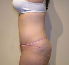 abdominoplasty abdominoplasty