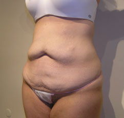 abdominoplasty abdominoplasty