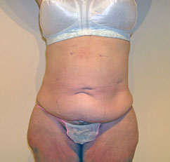 abdominoplasty abdominoplasty
