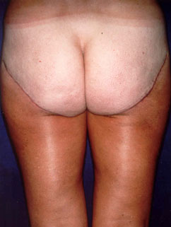 buttock lift buttock lift