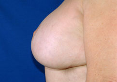 mastopexy mastopexy