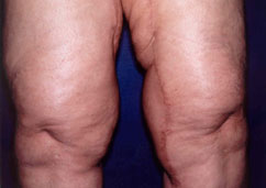 thighplasty thighplasty