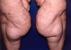 thighplasty thighplasty