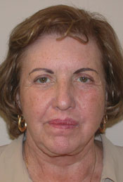 blepharoplasty