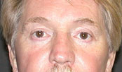 blepharoplasty