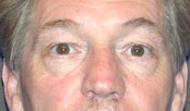 blepharoplasty