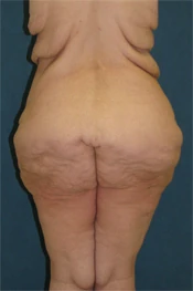 body lift body lift