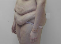 bodylift bodylift