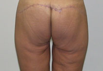 buttock lift buttock lift