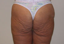 buttock lift buttock lift