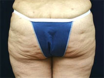 buttock lift buttock lift