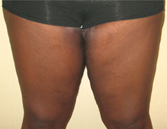 thighplasty thighplasty