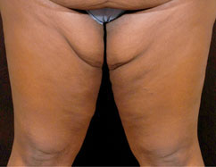 thighplasty thighplasty