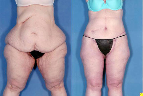 Body Lift - The American Society of Bariatric Plastic ...