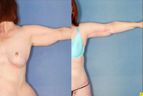 brachioplasty