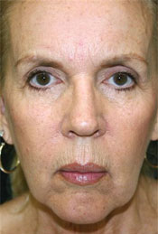 blepharoplasty