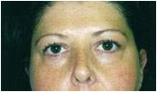 blepharoplasty