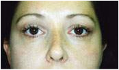 blepharoplasty