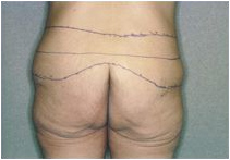 buttock lift buttock lift