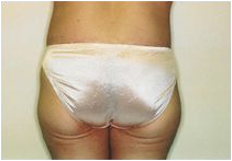 buttock lift buttock lift