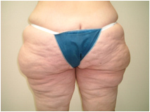 buttock lift buttock lift