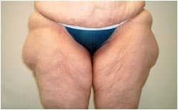 thighplasty thighplasty