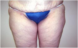 thighplasty thighplasty