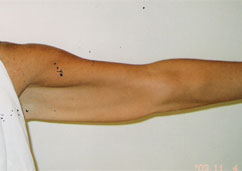 BRACHIOPLASTY BRACHIOPLASTY
