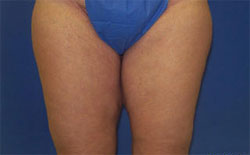 thighplasty thighplasty