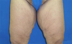 thighplasty thighplasty