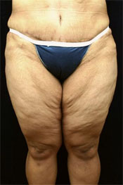 body lift body lift