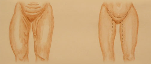 thighplasty thighplasty