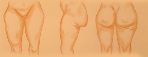 thighplasty thighplasty