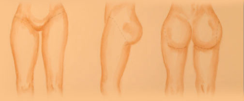 thighplasty thighplasty