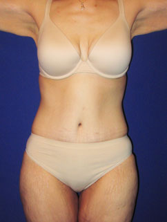abdominoplasty abdominoplasty