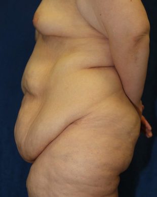 Body Lift or Lower Body Lift - American Society of Bariatric Plastic  Surgeons (ASBPS)